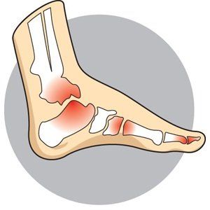 A sample photo of arthritis in the foot