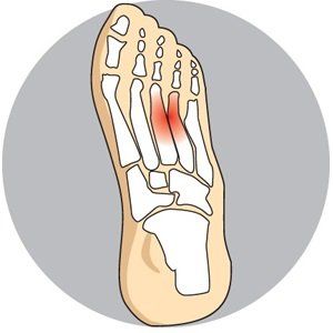 Example of a morton's neuroma