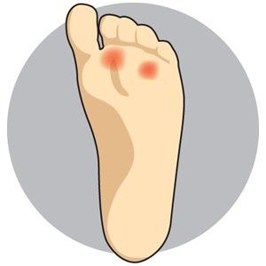 A sample photo of calluses on foot