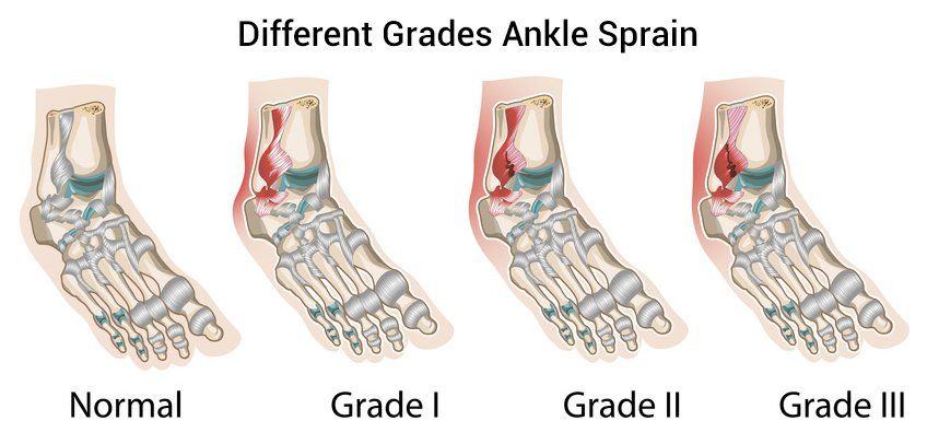 Different grades of ankle sprain