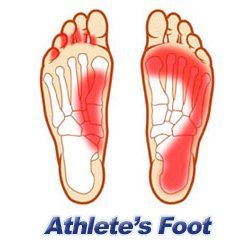 An athlete's foot