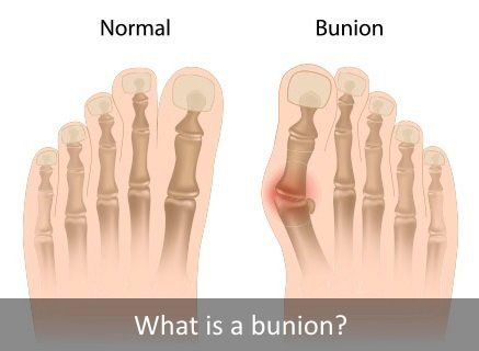 Normal foot and foot with bunion