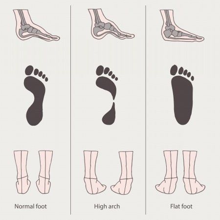 Comparison of Normal Foot, High Arch, and Flat Foot