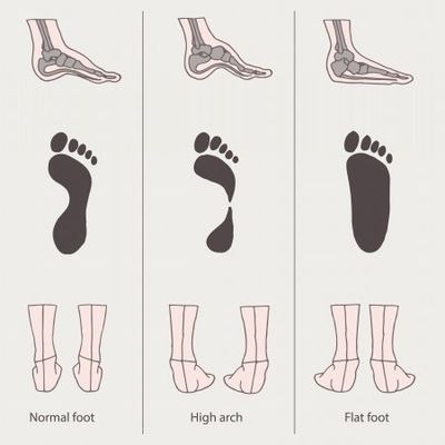 flat foot pronation