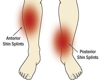 Comparison of  Anterior Shin Splints and Posterior Shin Splints