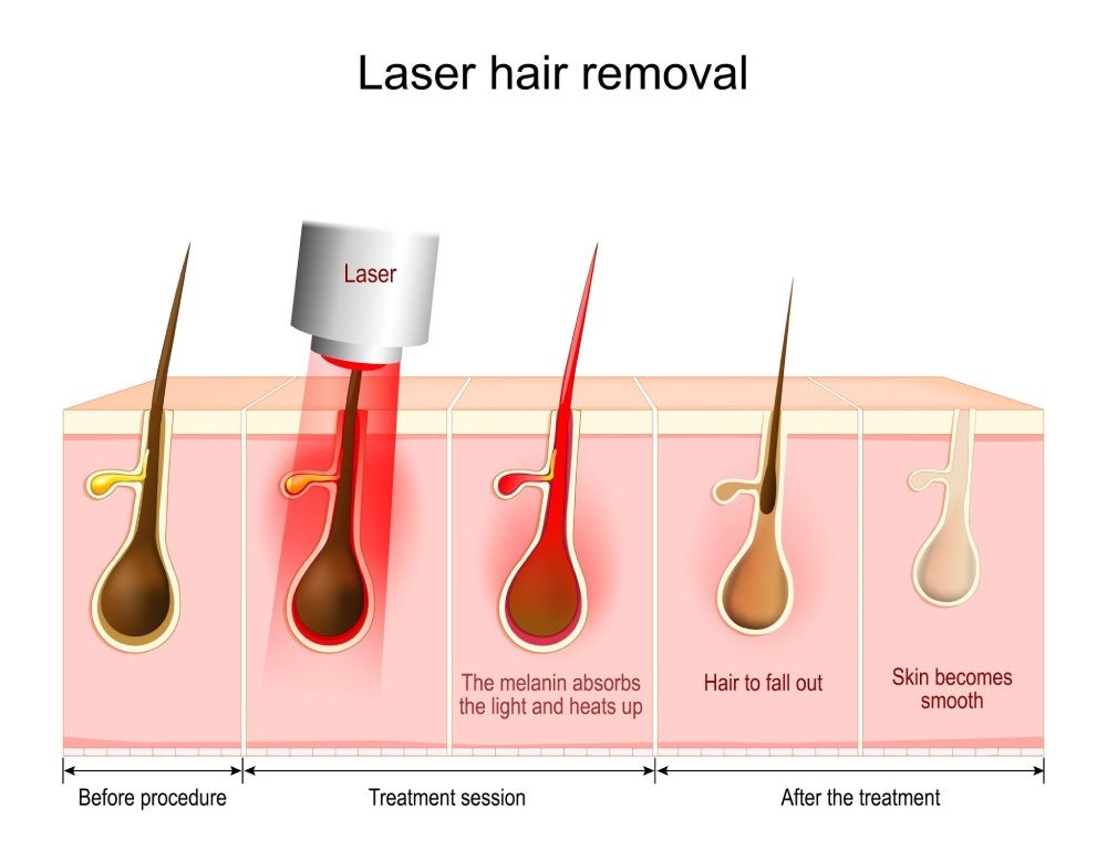 Full Body Laser Hair Removal