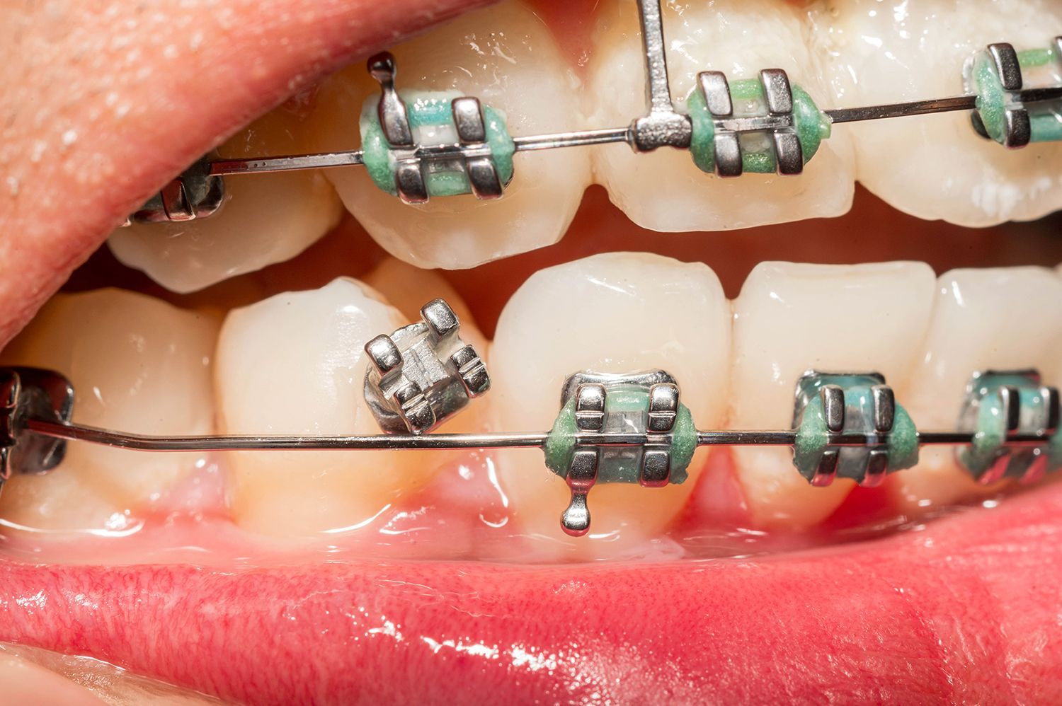 Teeth with metal braces showing brackets and wire during an orthodontic adjustment process
