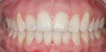 A close up of a person 's teeth with white teeth.