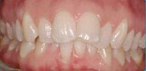 A close up of a person 's teeth with white teeth.