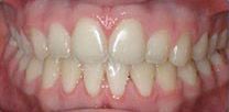 A close up of a person 's teeth and gums.
