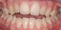 A close up of a person 's teeth and mouth.