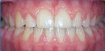 A close up of a person 's after teeth and gums.