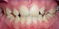 A close up of a person 's teeth with braces.