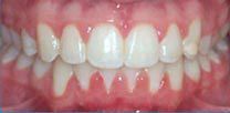 A after close up of a person 's teeth with white teeth.