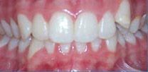 A before close up of a person 's teeth with white teeth.