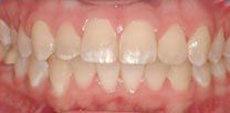 A after close up of a person 's teeth with white teeth.