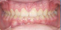 A after close up of a person 's mouth with their teeth showing.