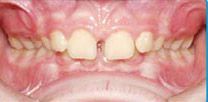 A before close up of a person 's teeth with a missing tooth.