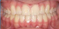 A after close up of a person 's teeth and mouth.