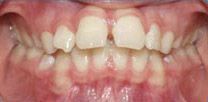 A before close up of a person 's teeth and mouth.
