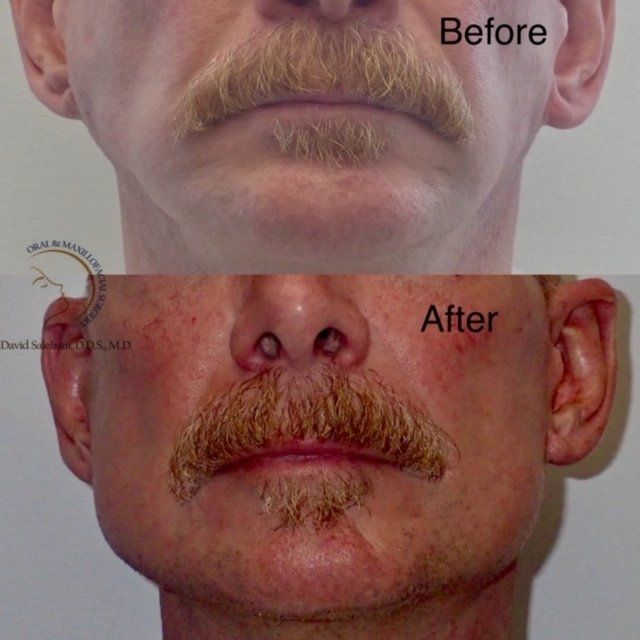 Jaw Implants Before and After 2