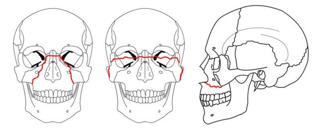 Orthognathic surgery - Wikipedia