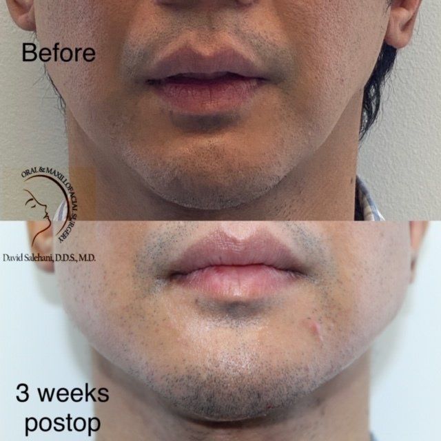 Jaw Implants Before and After 1
