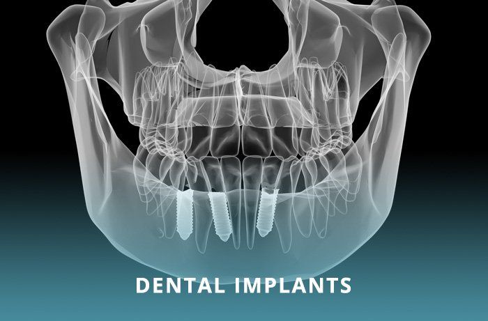 dental implants west hollywood