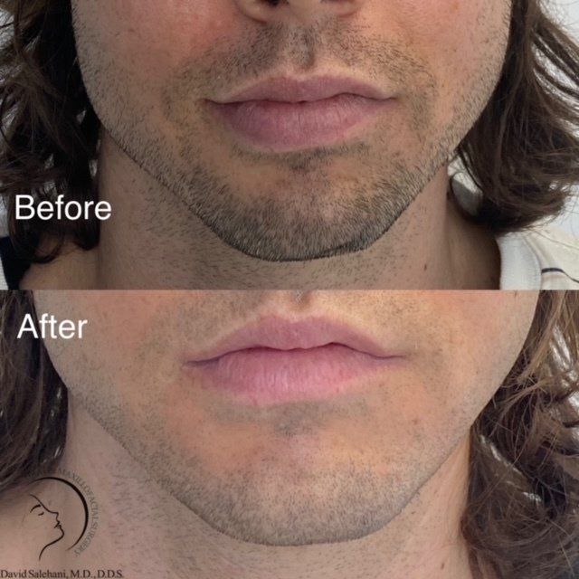 Jaw Implants Before and After 3