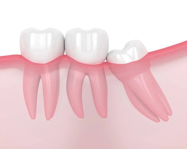 Wisdom tooth sitting at an angle within the gums