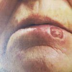 Lower Lip Cancer