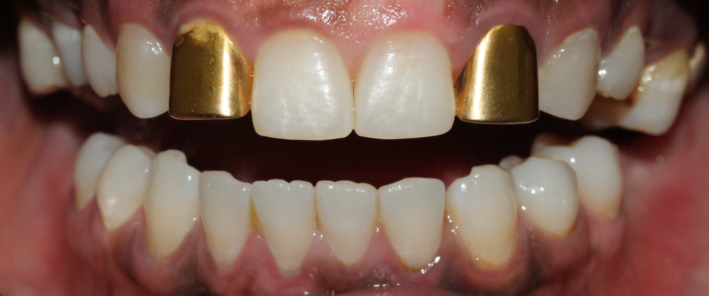 Gold Crown Replacement