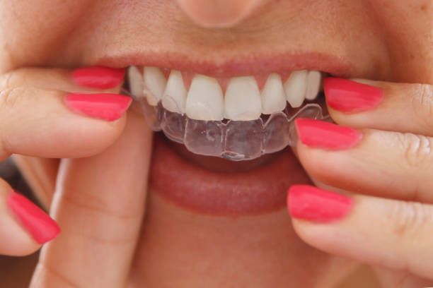 Close-up of a woman inserting Invisalign braces onto upper teeth with red-painted nails.