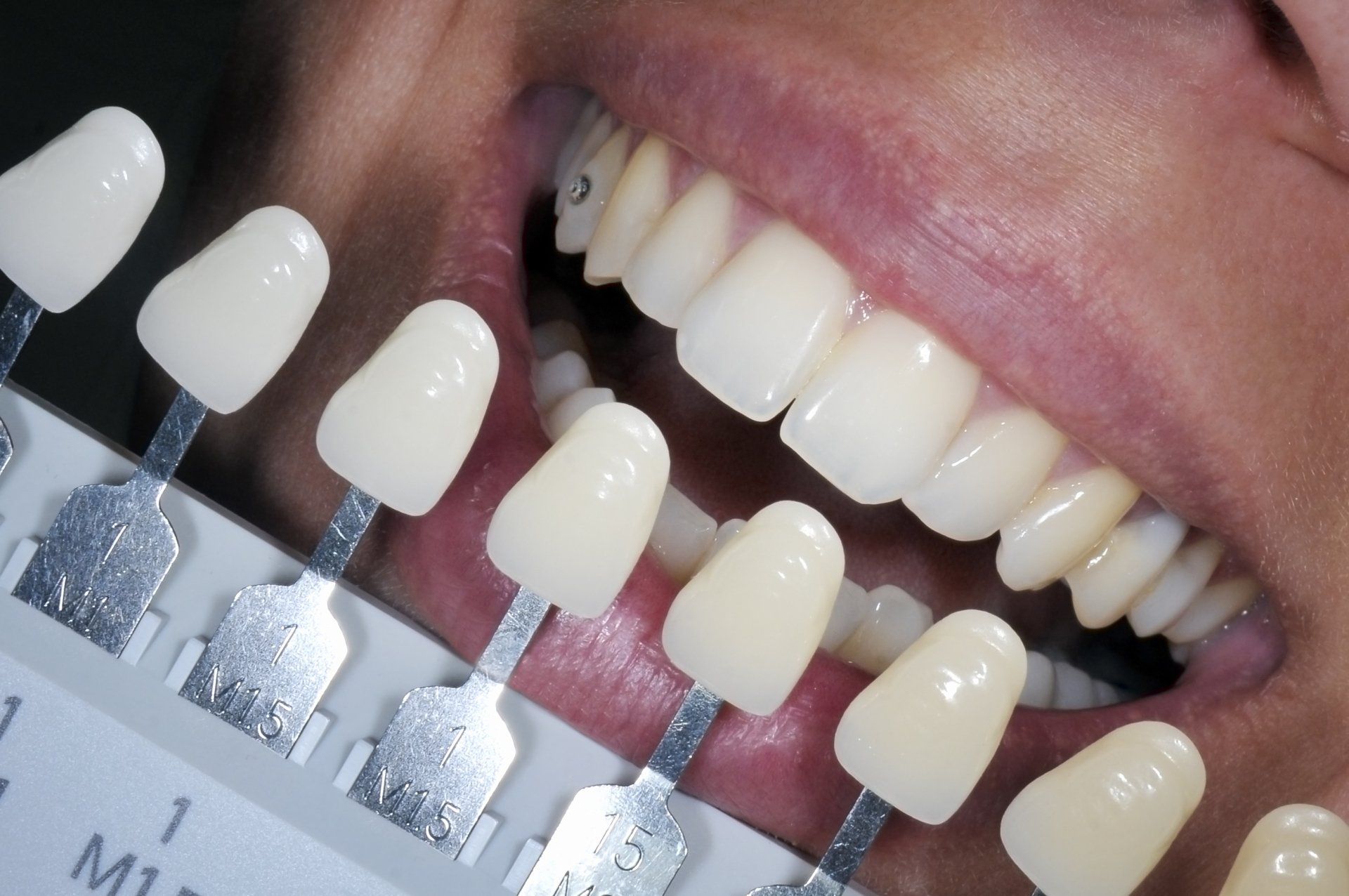 Teeth Whitening — Phoenix, AZ — Desert Dental
