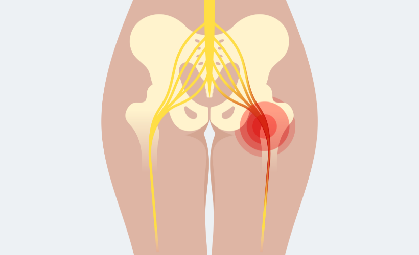 piriformis syndrome