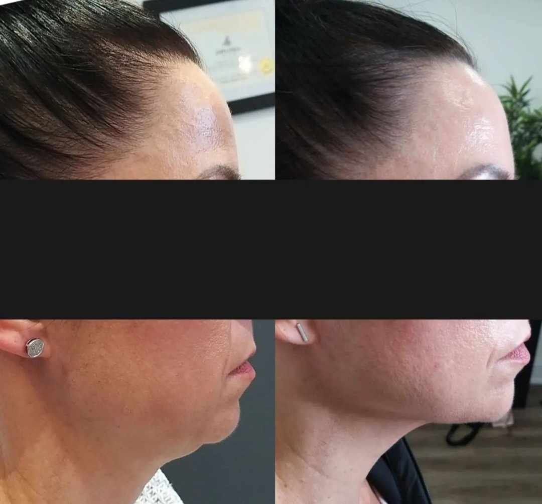 A before and after photo of a woman 's face and neck.