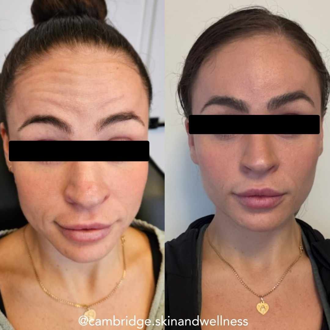A before and after photo of a woman 's forehead