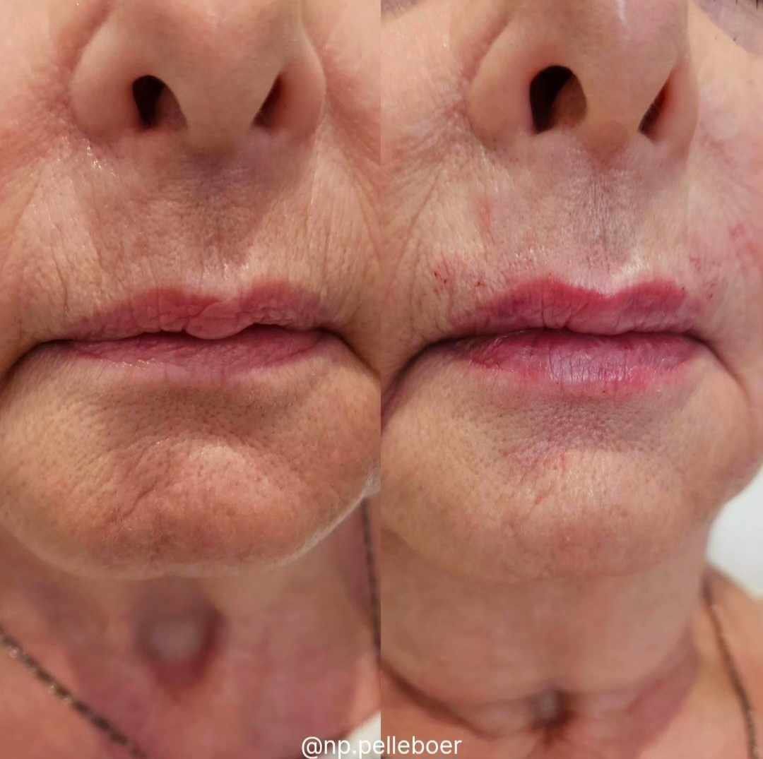 A before and after photo of a woman 's lips and nose.