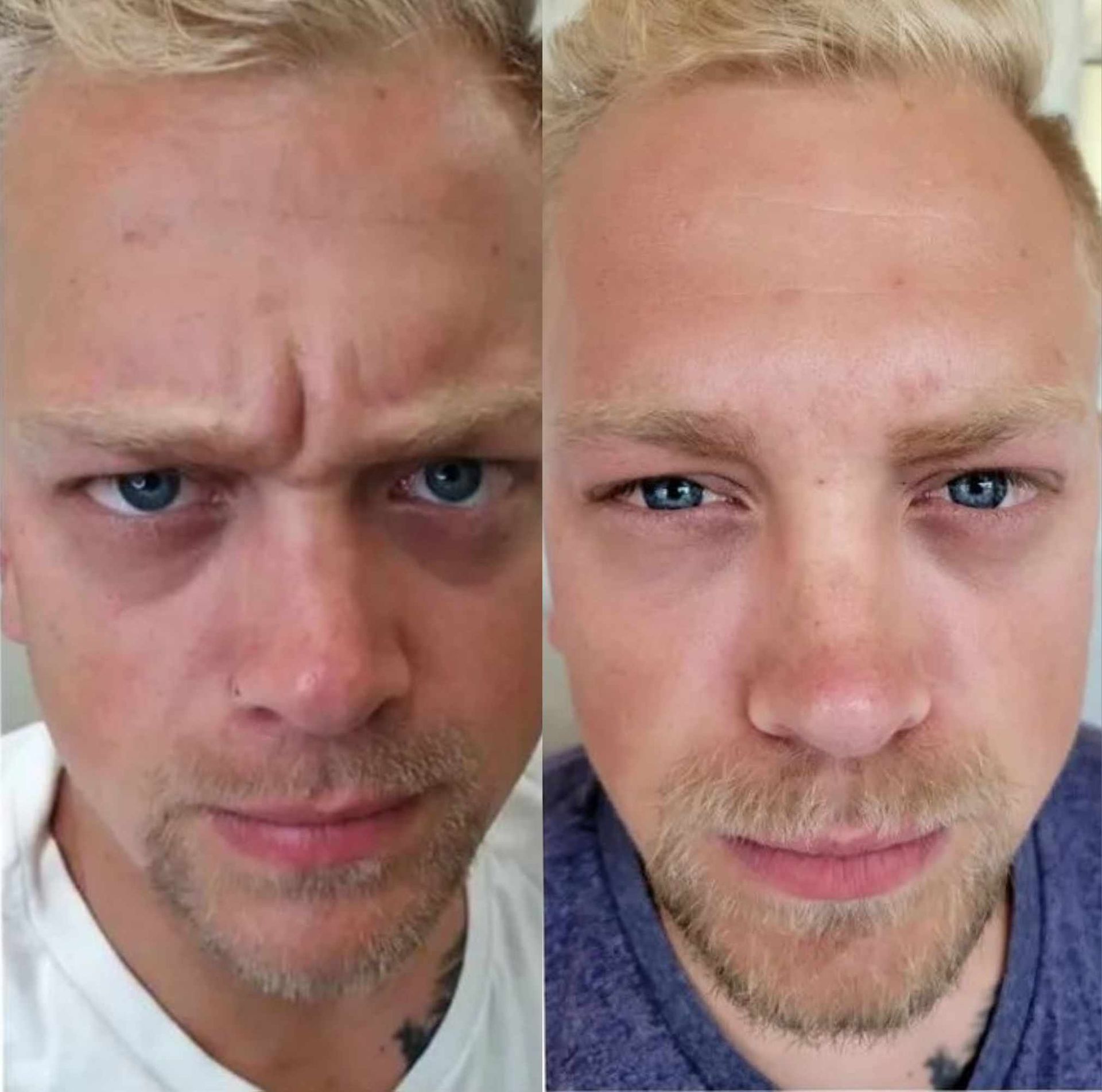 Two pictures of a man 's face before and after botox injections.
