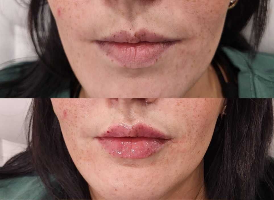 A before and after photo of a woman 's lips.