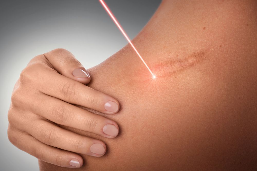 A laser treatment on a brown shoulder, focusing on a long scar. A laser beam emits from above.
