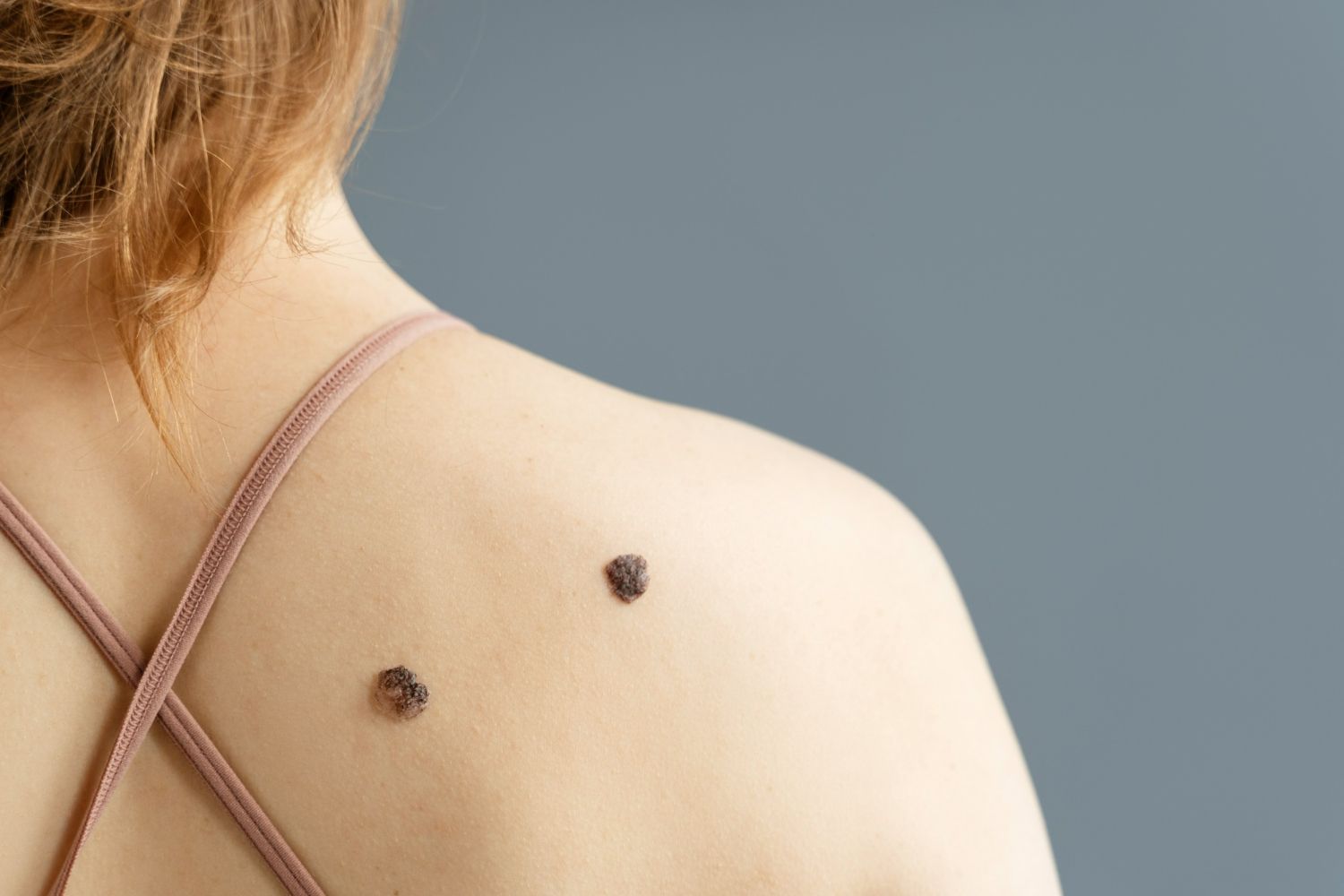 A person's shoulder and back with two brown moles, wearing a light-brown strapped top, against a gray background.