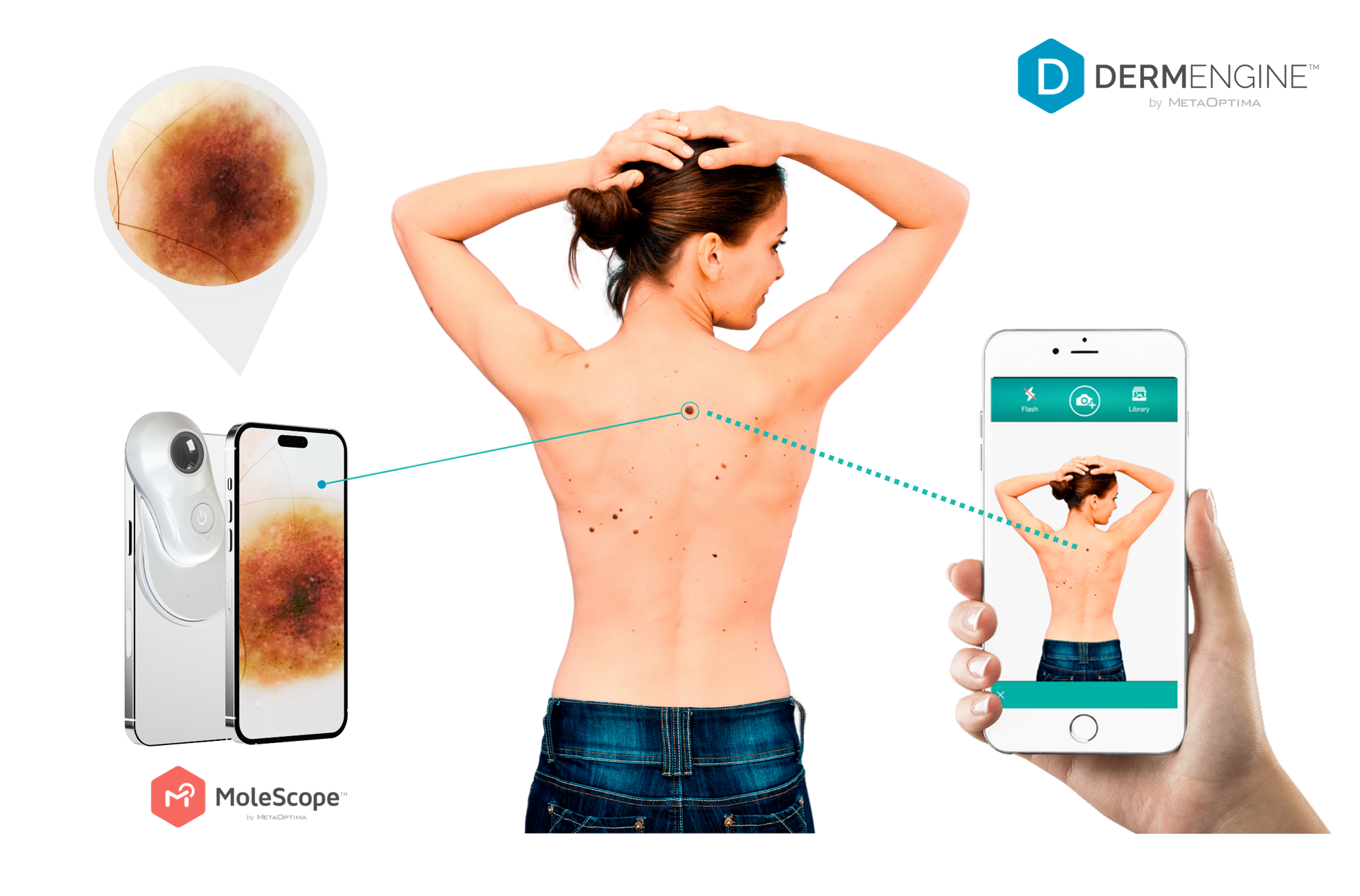 A mobile device with a dermatoscope capturing a skin lesion, alongside a person's back being scanned via a mobile app.