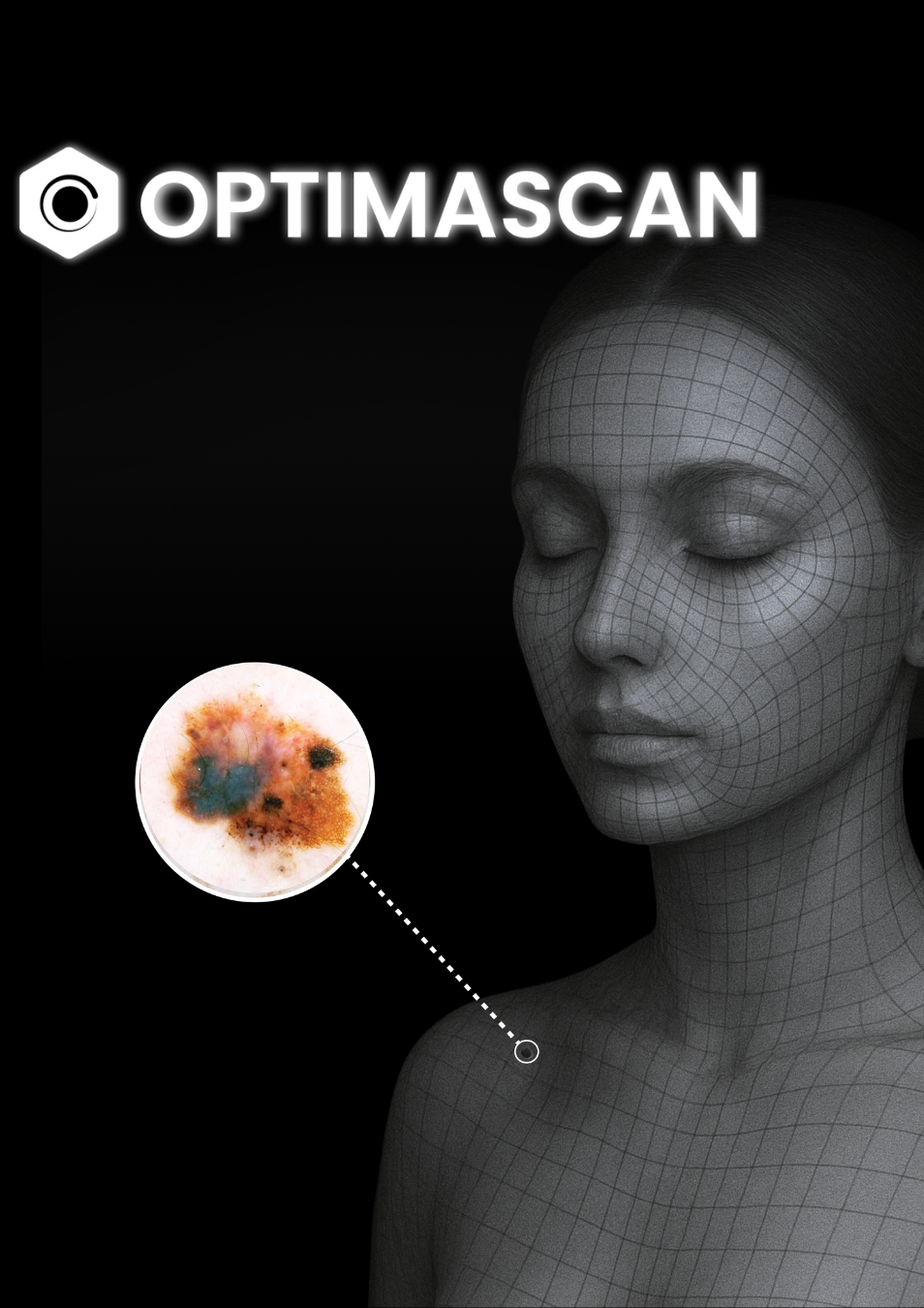 A digital wireframe bust of a human head and shoulders with a detailed circular inset of a skin lesion on the collarbone.