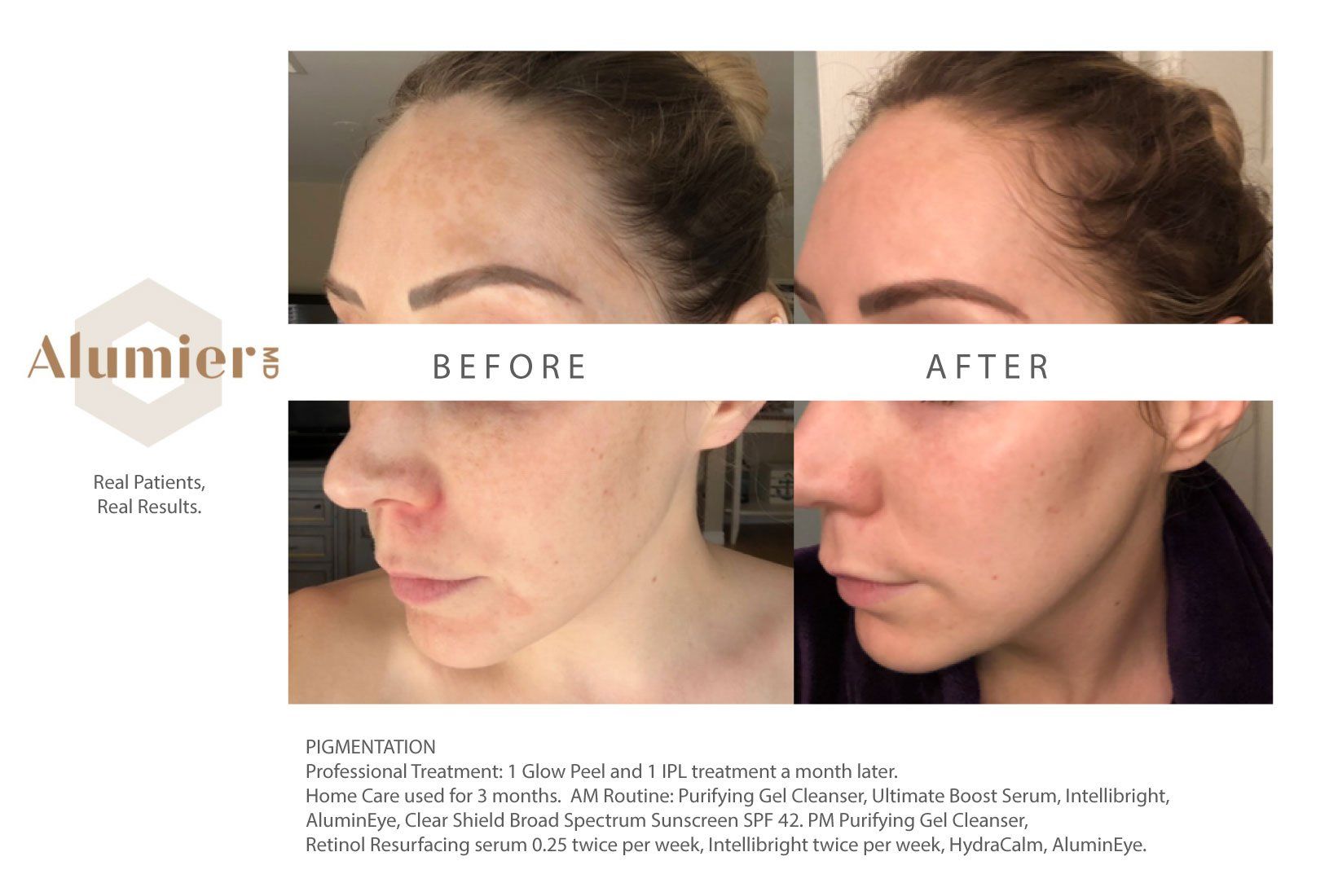 A before and after photo of a woman 's face.