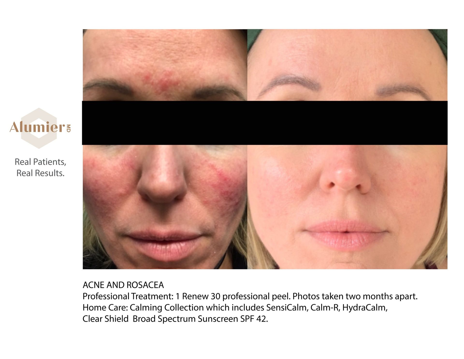 A before and after photo of a woman 's face with acne and redness.
