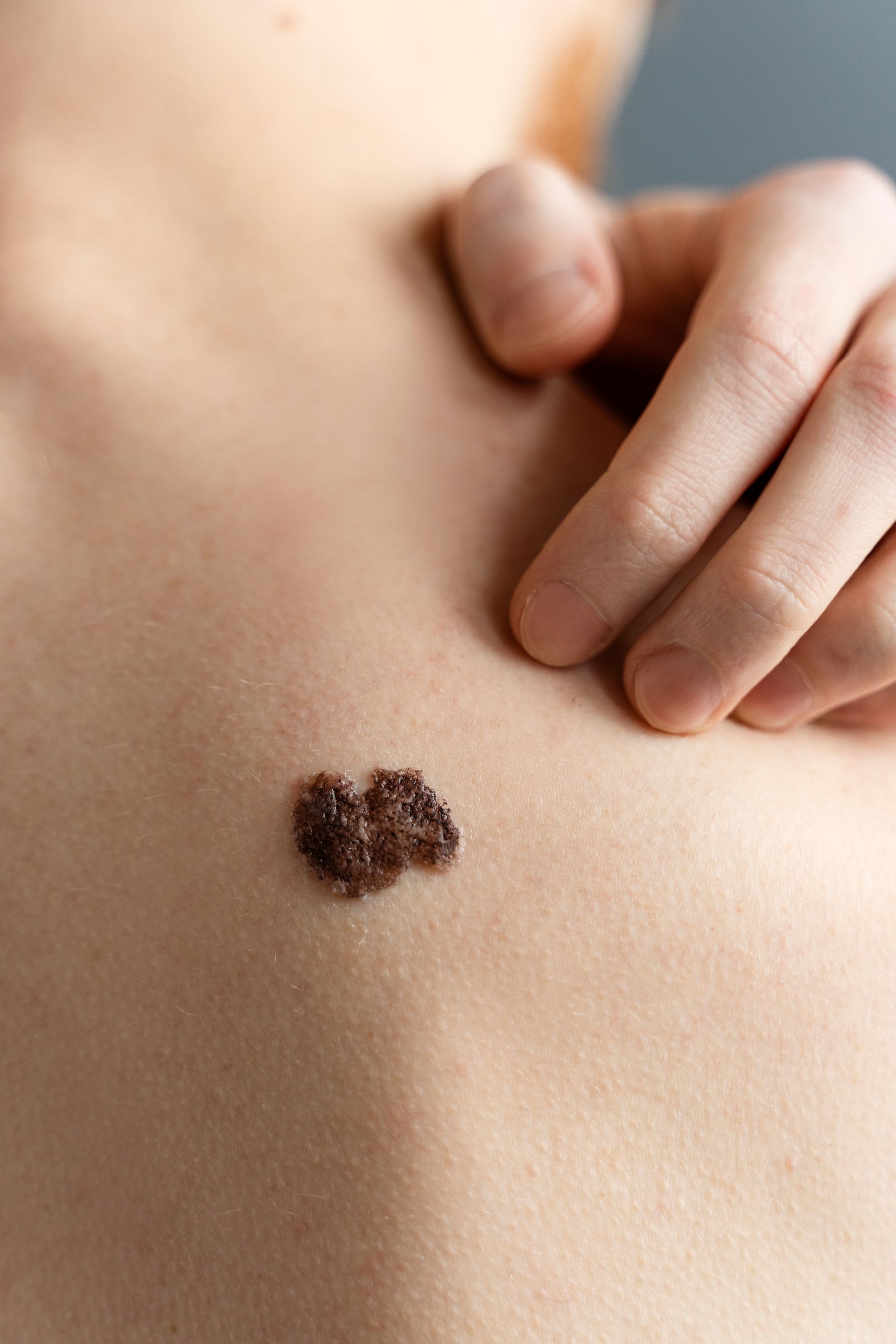 A person is touching a small brown spot on their chest.