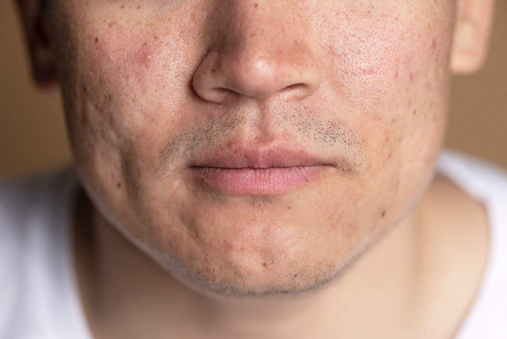 A close up of a man 's face with acne and a beard.