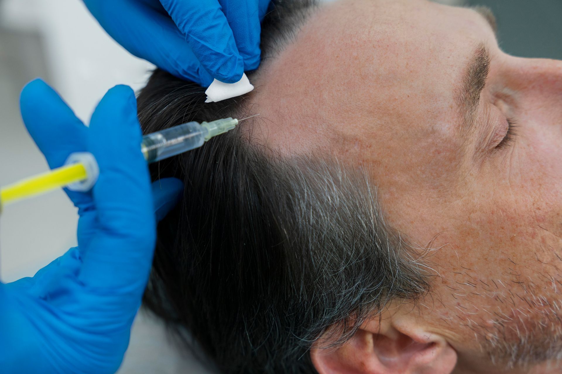 Gloved hands inject treatment into a man’s scalp with a syringe near his hairline