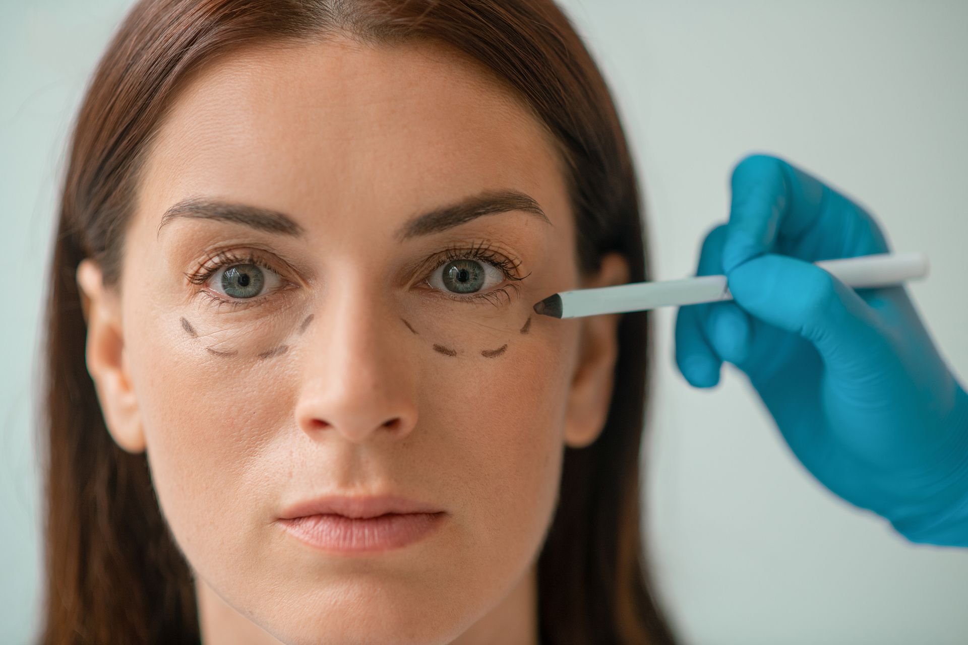 Woman with markings around eyes for cosmetic surgery; hand holding pen.
